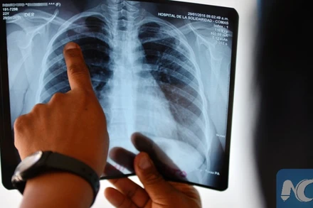 Phổi bệnh nhân nhiễm lao. (Ảnh tư liệu Tân Hoa xã)