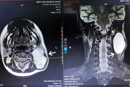 Hình ảnh chụp cộng hưởng từ cho thấy khối u có kích thước lớn, nằm ở vị trí nguy hiểm, gần các dây thần kinh trọng yếu.