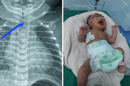 Kon Tum: Phẫu thuật thành công bệnh teo thực quản bẩm sinh cho trẻ 3 ngày tuổi