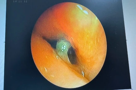 Hình ảnh nội soi mảnh xương sắc cạnh nằm trong đường thở bệnh nhân. (Ảnh: Bệnh viện cung cấp)