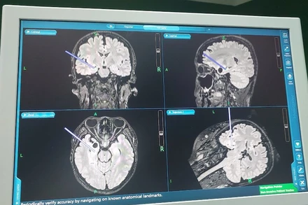 Hình ảnh hệ thống định vị trong mổ của bệnh nhân.