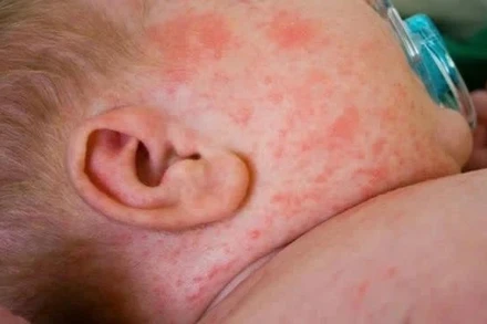 [Video] Hà Nội ghi nhận thêm 189 ca mắc sởi trong một tuần