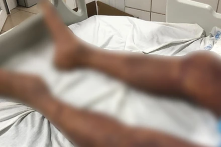 Một trường hợp toàn thân tím đen vì mắc liên cầu lợn. (Ảnh: Vietnam+)