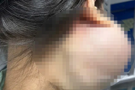 Hình ảnh khối u của người bệnh trước khi phẫu thuật