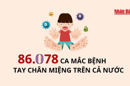 [Infographic] 86.078 ca mắc bệnh tay chân miệng trên cả nước