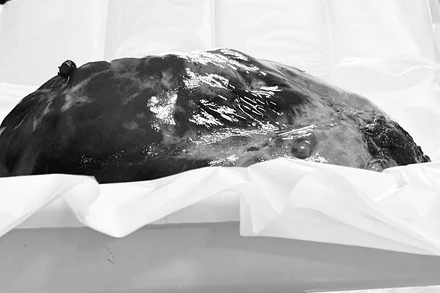 Khối u trung thất nặng 3,6kg