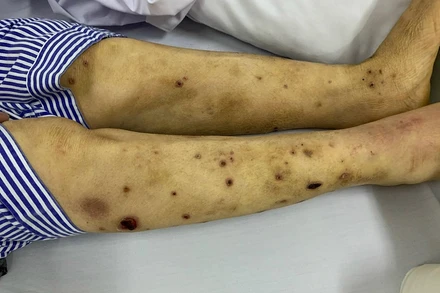 Tổn thương của bệnh nhân.