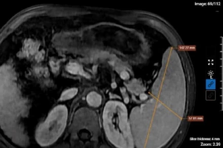 Kết quả chụp MRI của bệnh nhân nghiện rượu cho thấy hình ảnh xơ gan lách to, dịch bao quanh gan. (Ảnh: BVCC)