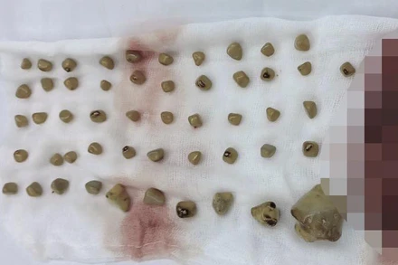 Hình ảnh 54 viên sỏi được lấy ra từ túi mật. 