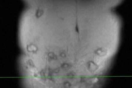 Bụng bệnh nhân có nhiều khối áp xe.