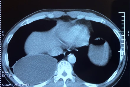 Tổn thương trên phim cắt lớp vi tính lồng ngực.