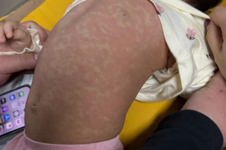 Bệnh nhi phát ban khi mắc sởi.