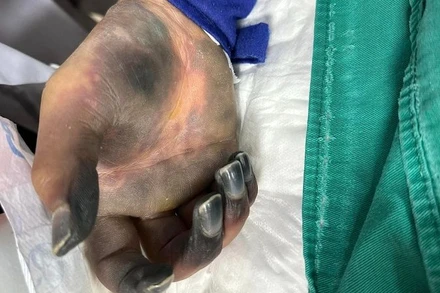 Bệnh nhân hoại tử ngón tay, ngón chân. 