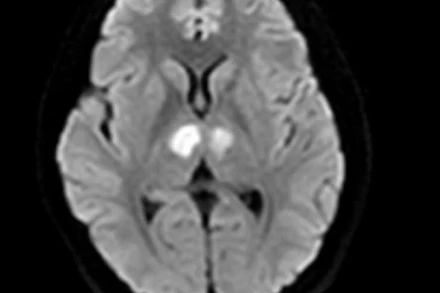 Phim chụp cho thấy não bệnh nhân bị tổn thương vùng đồi thị hai bên.