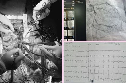 Nhồi máu cơ tim gây biến chứng thủng vách liên thất