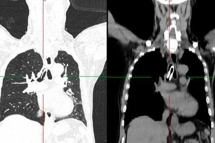 Hình ảnh chụp cắt lớp vi tính, dị vật đường thở.