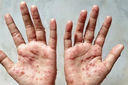 Các ban đỏ nổi trên tay một bệnh nhân mắc đậu mùa khỉ. (Ảnh: Shutterstock/TTXVN)
