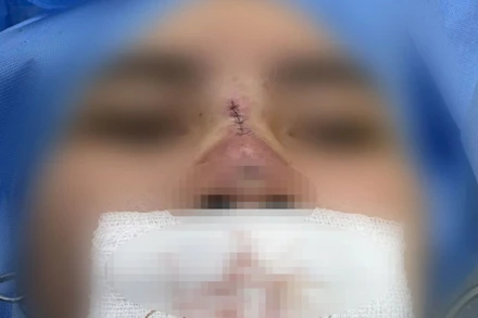 Bệnh nhân bị hoại tử mũi sau nâng mũi căng chỉ ở một cơ sở thẩm mỹ không uy tín.