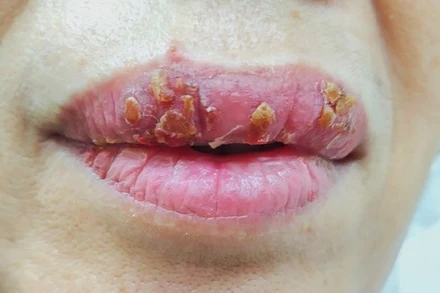 Nhiễm trùng môi vì làm đẹp cấp tốc 