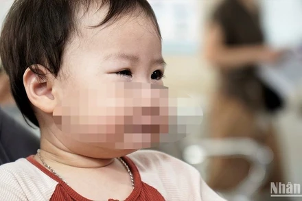 Bệnh nhi khám mắt tại Bệnh viện Mắt Trung ương. (Ảnh: THẾ KHẢI)