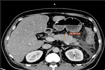 Trên hình ảnh chụp cắt lớp vi tính ghi nhận những bất thường tại tuyến tụy.