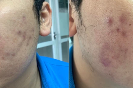 Bệnh nhân gặp biến chứng sau khi tiêm meso để làm đẹp.