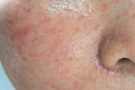 Một trường hợp bị mẩn đỏ li ti sau tự peel da tại nhà.