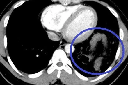 Đại tràng nằm trong ngực trái trên phim cắt lớp vi tính ngực.