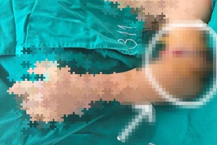 Cánh tay của bệnh nhân được nối thành công. 