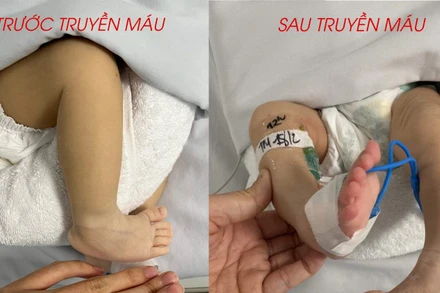 Bệnh nhi bình phục sau khi được truyền máu. 