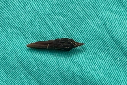 Dị vật là hạt táo đỏ gây ra tình trạng thủng ruột cho người bệnh.