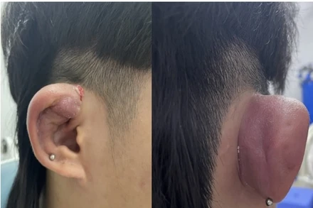 Bệnh nhân sưng nóng đỏ ở vành tai phải, có lỗ rò mủ.