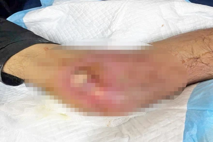 Vết thương của người bệnh.