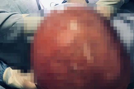 Khối u xơ tử cung nặng tới 10kg.