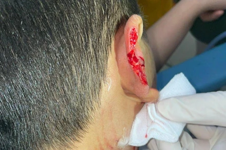 Bé N. bị chó lạ tấn công, cắn đứt vành tai.