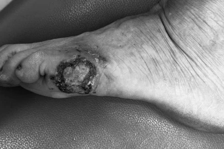 Phát hiện ung thư tế bào hắc tố từ một mảng đen ở bàn chân