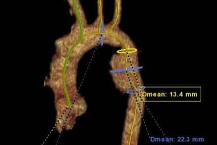 Hình ảnh dựng 3D tổn thương động mạch chủ.