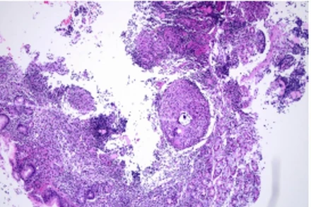 Hình ảnh xét nghiệm mô bệnh học cho kết quả tổn thương viêm hạt hướng đến do Mycobacterium.