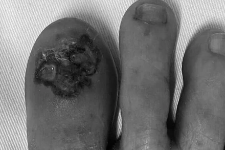 Hình ảnh ung thư tế bào hắc tố: màu sắc không đồng đều, bờ không rõ và không đều, có loét.