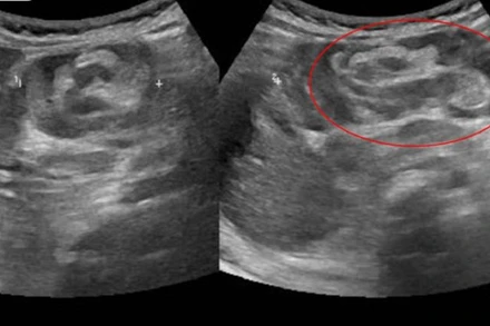 Kết quả siêu âm phát hiện bé trai 8 tháng có khối lồng ruột dài 40mm.