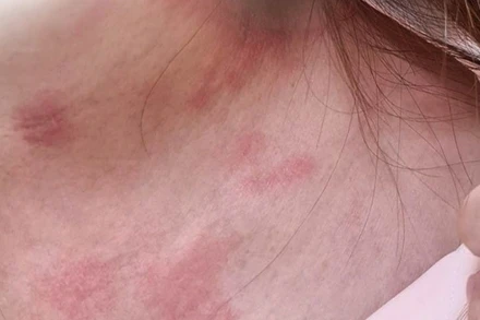 Tổn thương do kiến ba khoang. 