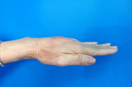 Bàn tay bị biến chứng u hạt sau khi tiêm filler tay.