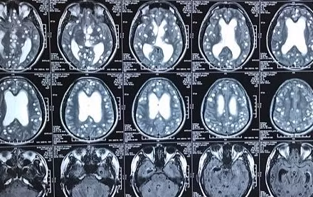 Ảnh minh họa tổn thương não do ổ sán não. 