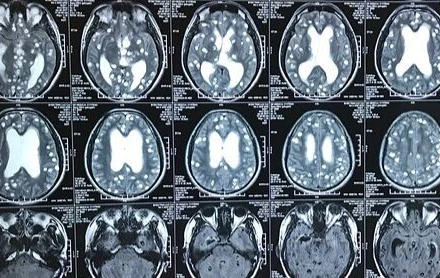 Ảnh minh họa tổn thương não do ổ sán não. 