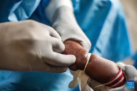 Một đứa trẻ bị mắc bệnh đậu mùa khỉ đang được điều trị tại bệnh viện ở vùng Nyiragongo gần Goma, tỉnh Bắc Kivu, miền đông Cộng hòa Dân chủ Congo. Ảnh minh hoạ: Tân Hoa xã