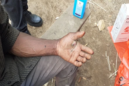 Một bệnh nhân nghi mắc bệnh than. Ảnh: WHO