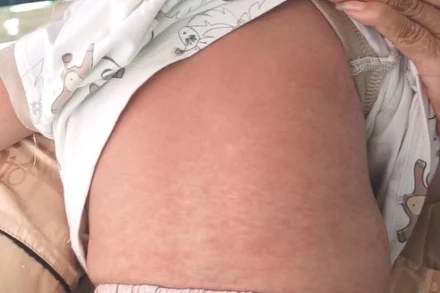 Các nốt phát ban trên trẻ bị bệnh sởi.