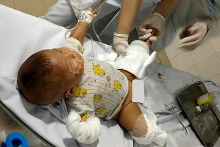 Cháu bé bị bỏng đang được điều trị tại Bệnh viện.