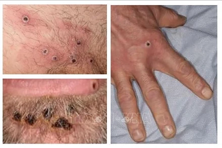 Các ban đậu mùa khỉ trên da của bệnh nhân. (Ảnh: AFP/TTXVN)