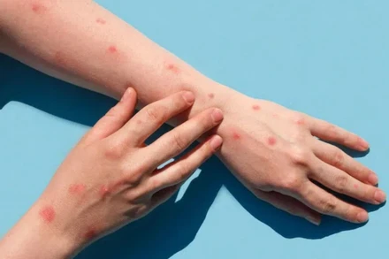 Ghi nhận ca bệnh đậu mùa khỉ đầu tiên ở Long An. (Ảnh minh họa)